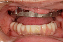 Attached Implant Bar